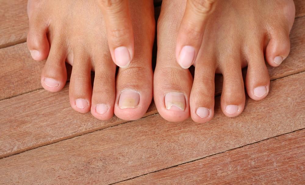 Glivice v naturopatski praksi