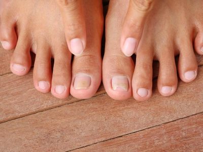 Glivice v naturopatski praksi